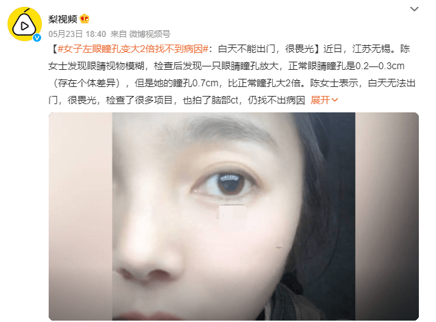 大可乐手机:女子左眼瞳孔变大2倍找不到病因，是不是总看手机累的？